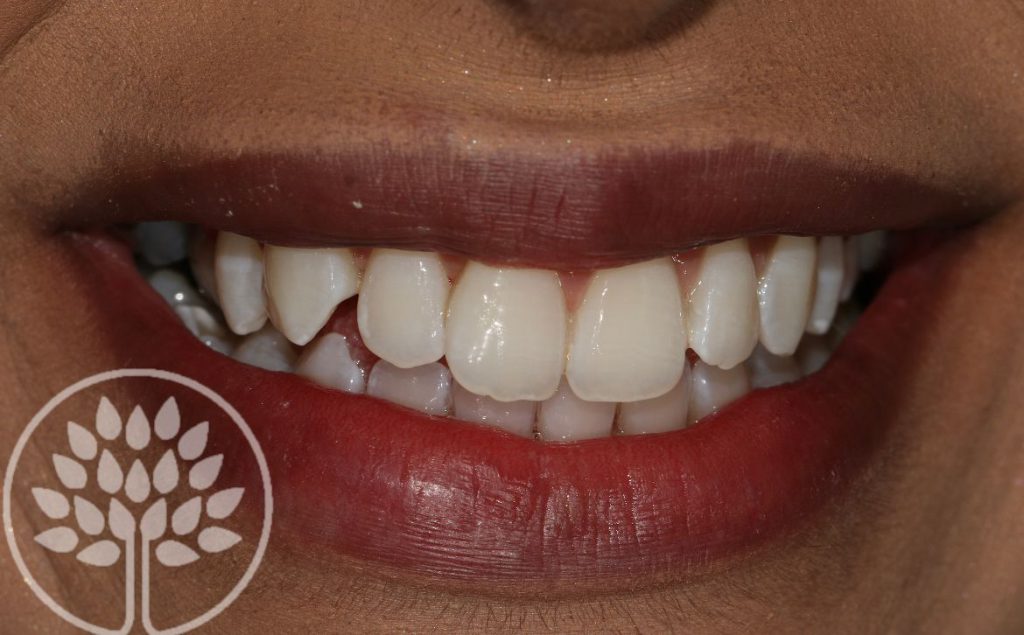 teeth whitening maidenhead